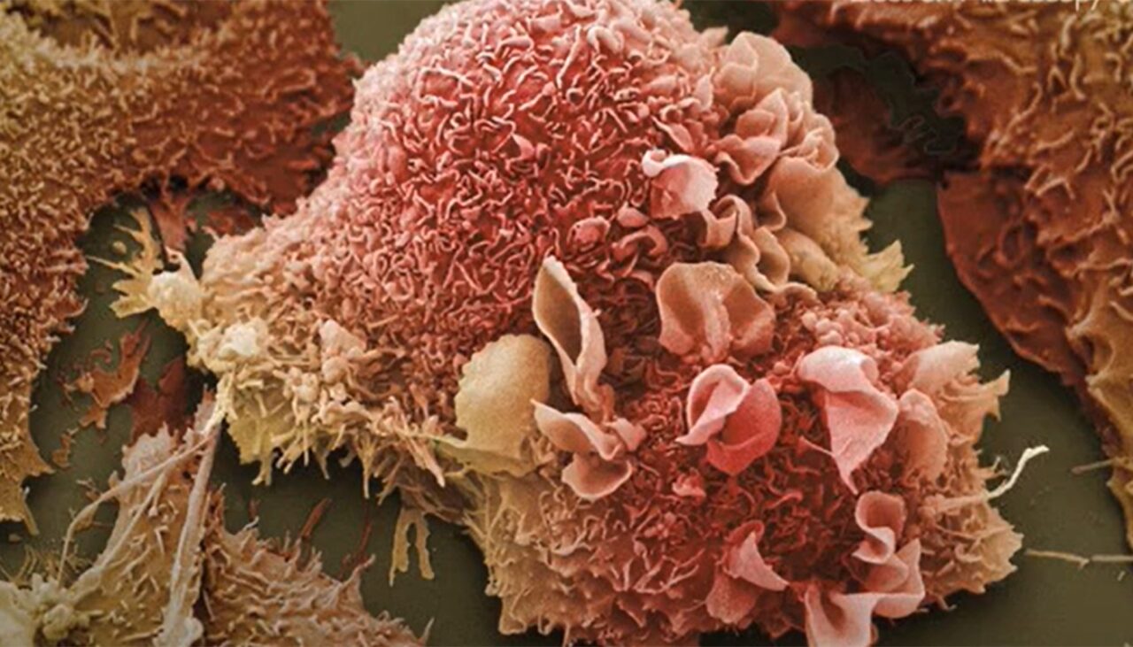 Descoperire revoluționară în medicină: bacterii care distrug CANCERUL, fără să implice sistemul imunitar