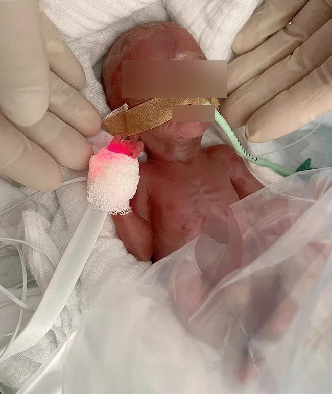 Minune medicală. Medicii din Germania au salvat o fetiță născută prematur, la doar 300 de grame. Cum a decurs tot procesul