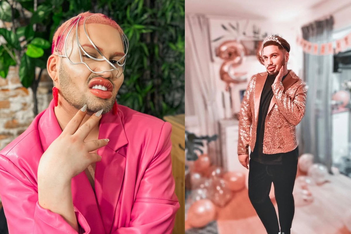 A cheltuit 90.000 euro pe 100 de operații estetice, inspirat de Michael Jackson: „Vreau să am cele mai mari buze din lume”