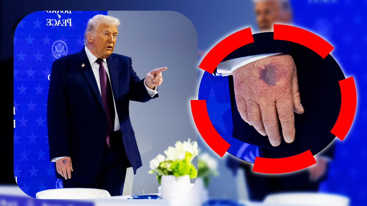 Trump a dat cu pumnul în masă la propriu. Casa Albă precizează că președintele și-a învinețit mâna când s-a lovit de masă la Consiliul pentru Pace