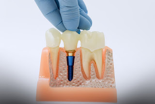 (P) De ce trebuie înțeles în context, nu izolat costul cu coroana pentru dinte