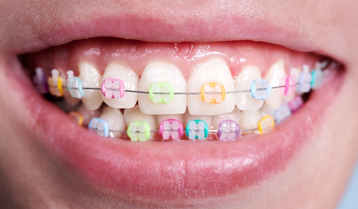 (P) Aparat dentar ceramic – confort și rezultate estetice