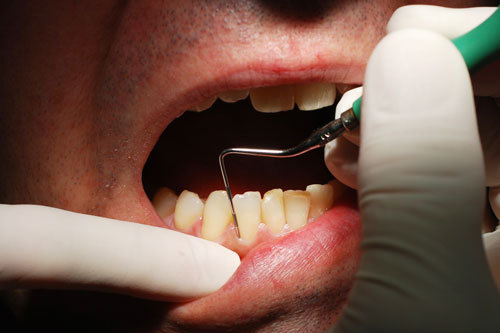 Cifre alarmante: Aproape 2 din 3 români au PROBLEME dentare / Aproape 80% preferă să ia medicamente în locul vizitei la stomatolog
