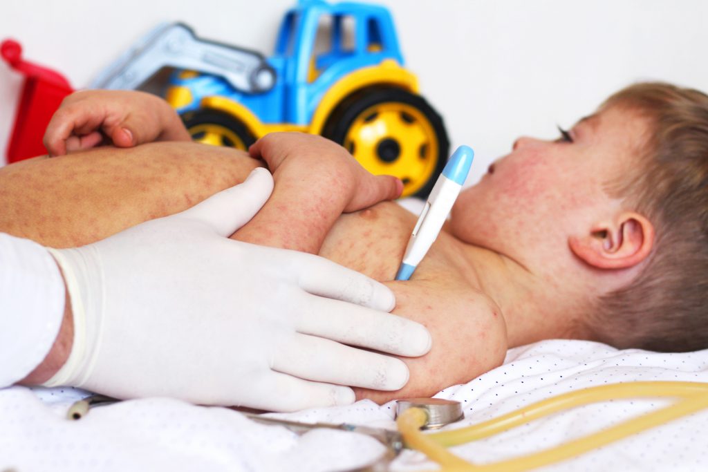 Rujeola, o amenințare globală iminentă din cauza pandemiei. Aproape 40 de milioane de copii nu au fost vaccinați împotriva bolii anul trecut / Avertismentul OMS