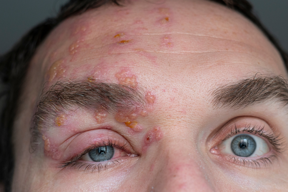 Infecția pe care 90% dintre noi o avem în organism și care nu se vindecă niciodată! Este extrem de contagioasă!