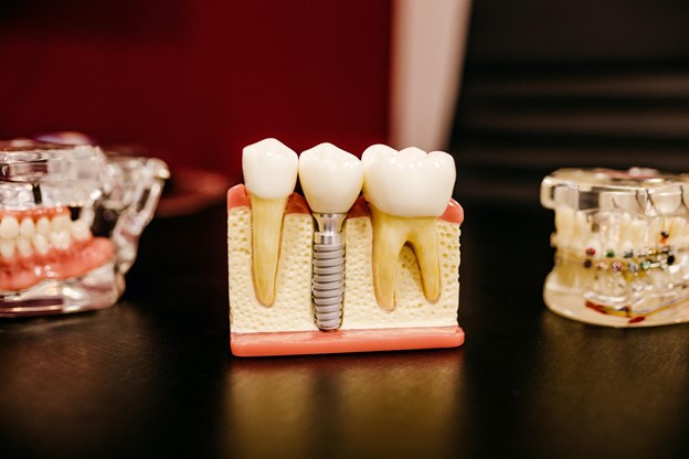 5 motive să-ți faci un implant dentar