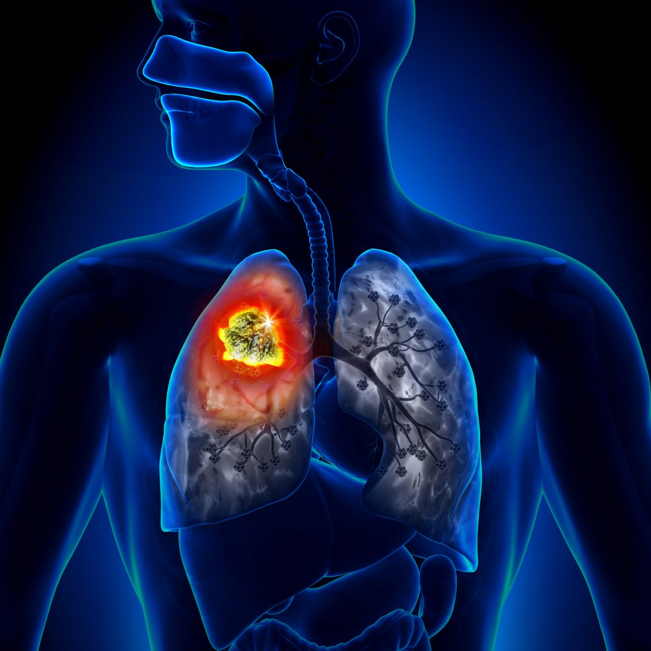 Românii care vor să afle dacă au simptomele cancerului pulmonar pot face un test online