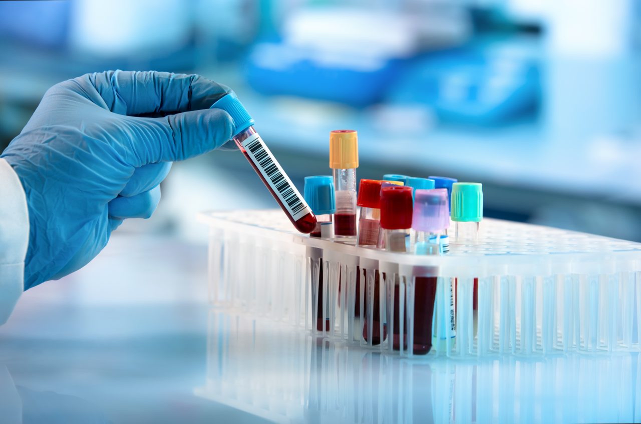 Analiza de sânge care ajută la identificarea a peste 50 de tipuri de cancer
