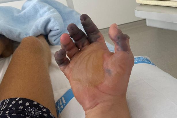 Un turist a rămas două degete, după ce a fost mușcat de un păianjen, la Ibiza