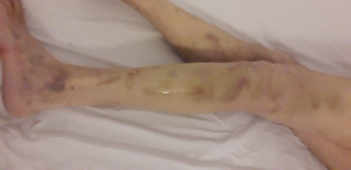 Acuzații de maltratare și neglijență la un azil din Câmpina, după ce un vârstnic a fost găsit de fiica sa plin de răni și înfometat: „Tată mi-a spus că acolo era pușcărie”