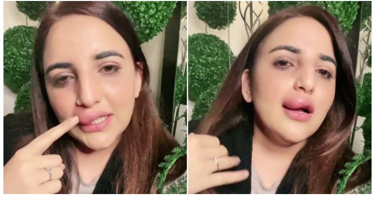 VIDEO | O vedetă de pe TikTok susține că a rămas cu buza umflată, după ce autoritățile i-au înghețat conturile și nu a mai avut bani pentru continuarea intervenției estetice