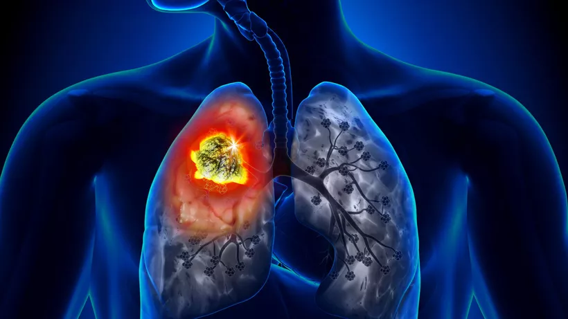 Din ce orașe poluate provin mulți români care mor de cancer pulmonar. Aproape 11 mii de pacienți sunt uciși anual de această boală