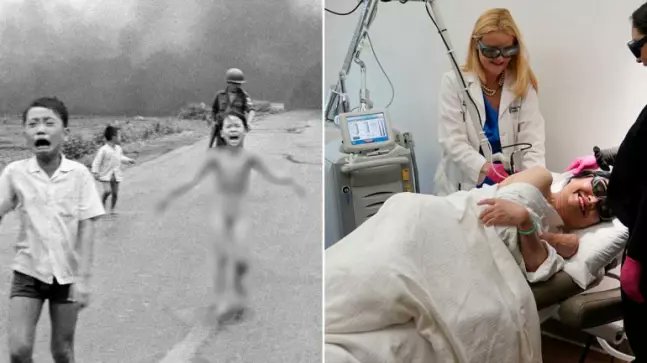 ”Fetița Napalm” din Vietnam a făcut ultimul tratament de piele la 59 de ani. Care este povestea ei