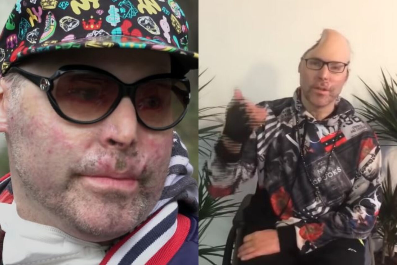 VIDEO | Rapper mutilat în timp ce prepara ulei de canabis. Niko a rămas fără jumătate din craniu, în urma unei explozii: „Am făcut o greșeală uriașă”