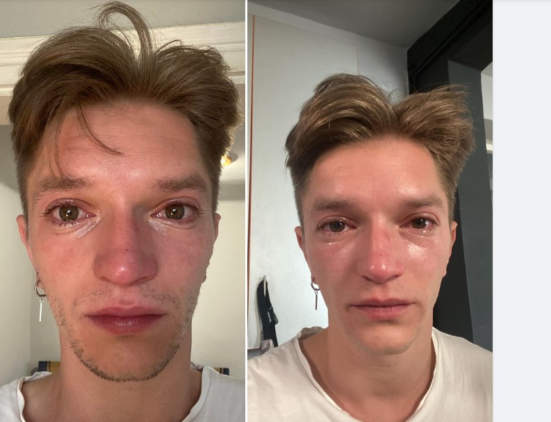 Anchetă la Spitalul Judeţean Sibiu după ce un actor a fost trimis acasă din UPU cu arsură de cornee