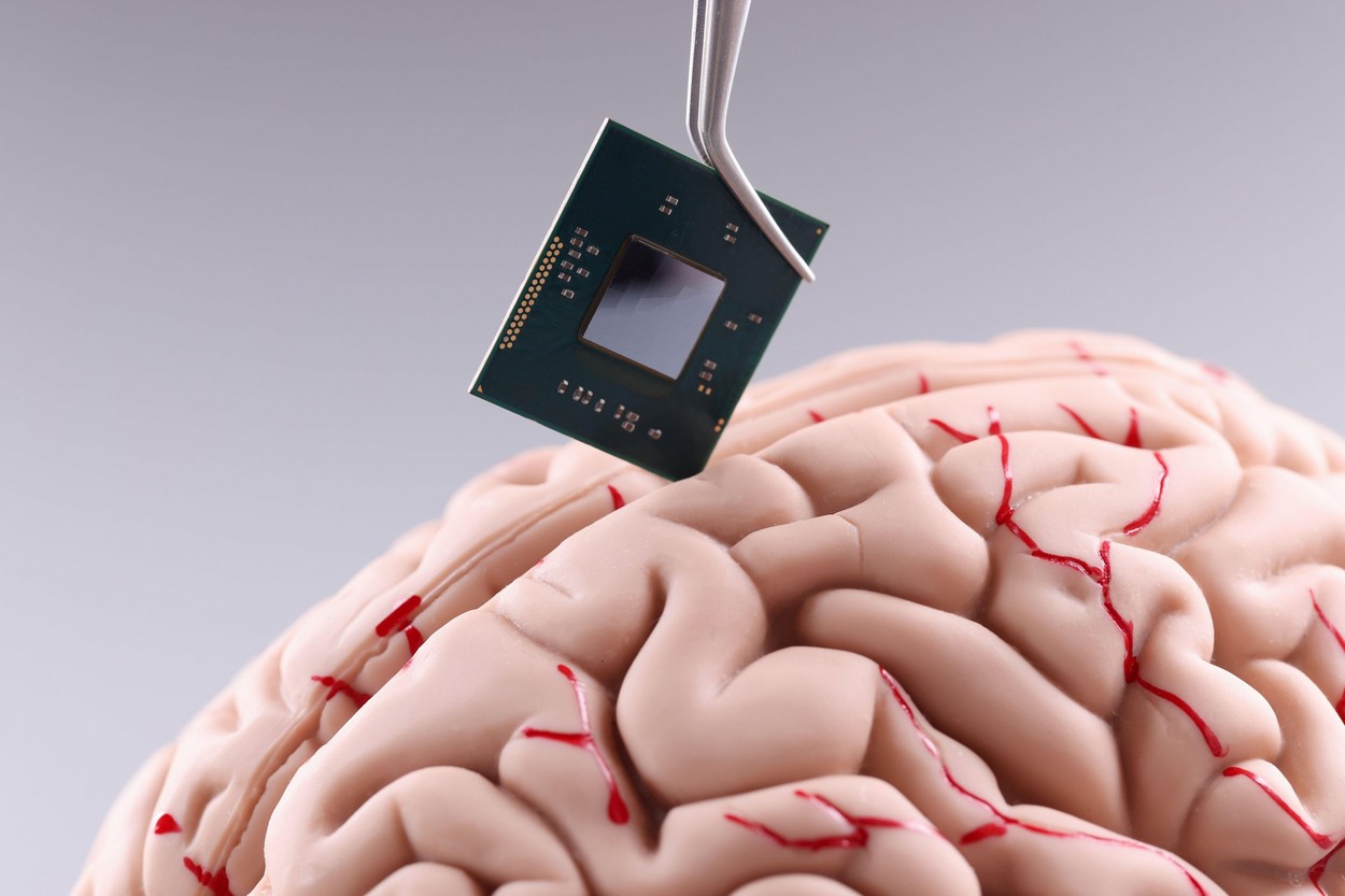 Vești extraordinare pentru personale care suferă de paralizie. Primul implant al unui cip neuronal a fost implantat în creierul uman