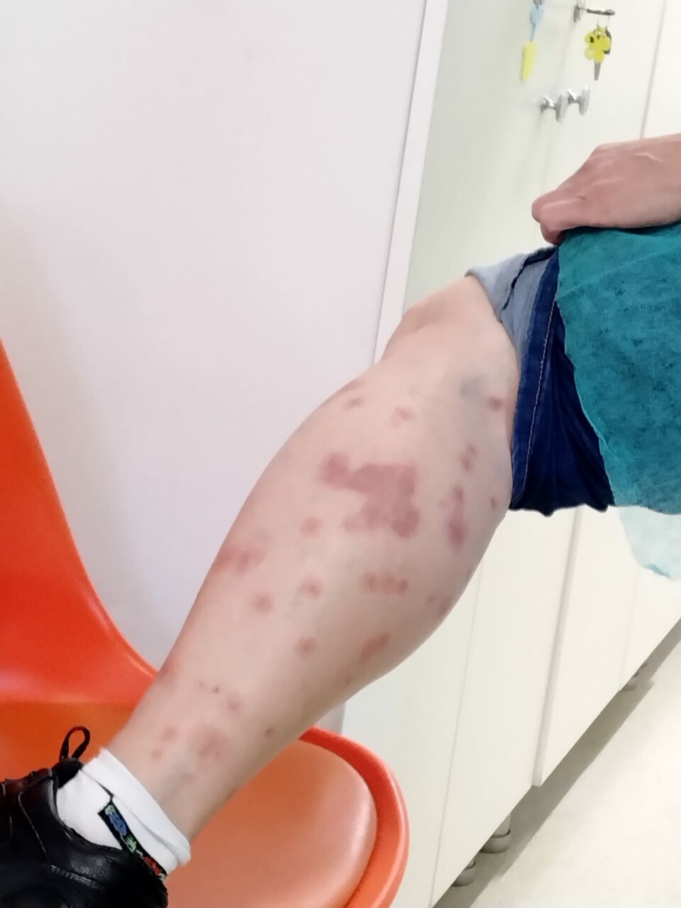 O turistă a fost mușcată de ploșnițe într-un hotel din România. Femeia a ajuns la spital