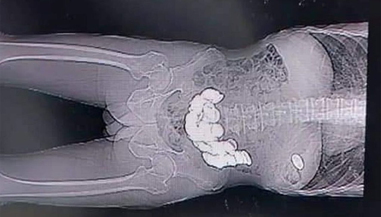 Caz unic în istoria omenirii! Ce au găsit medicii în stomacul unui bărbat care se internase pentru că se simțea „balonat”