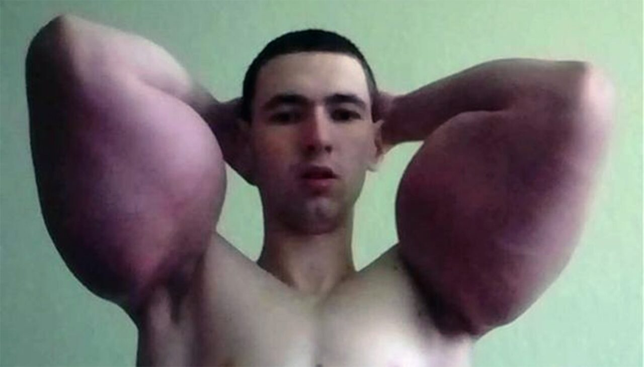 Ireal cum a ajuns să arate tânărul din imagine, după ce și-a înjectat ulei în bicepși
