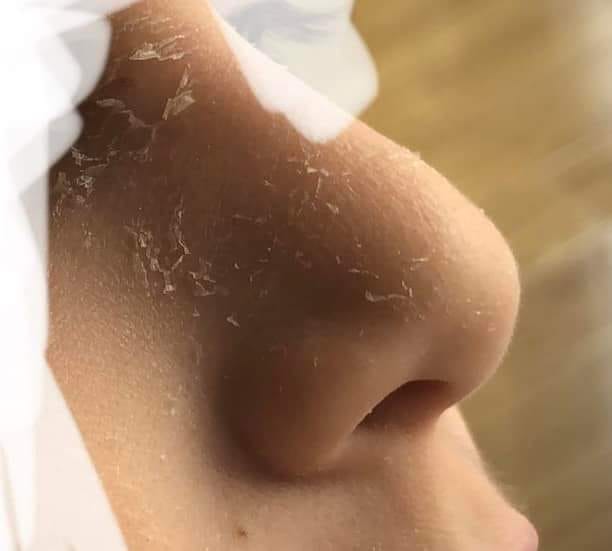 Șase elevi din Ilfov au ajuns la spital, după ce au fost expuși la raze ultraviolete în școală. Chiar învățătoarea lor pornise lampa în clasă