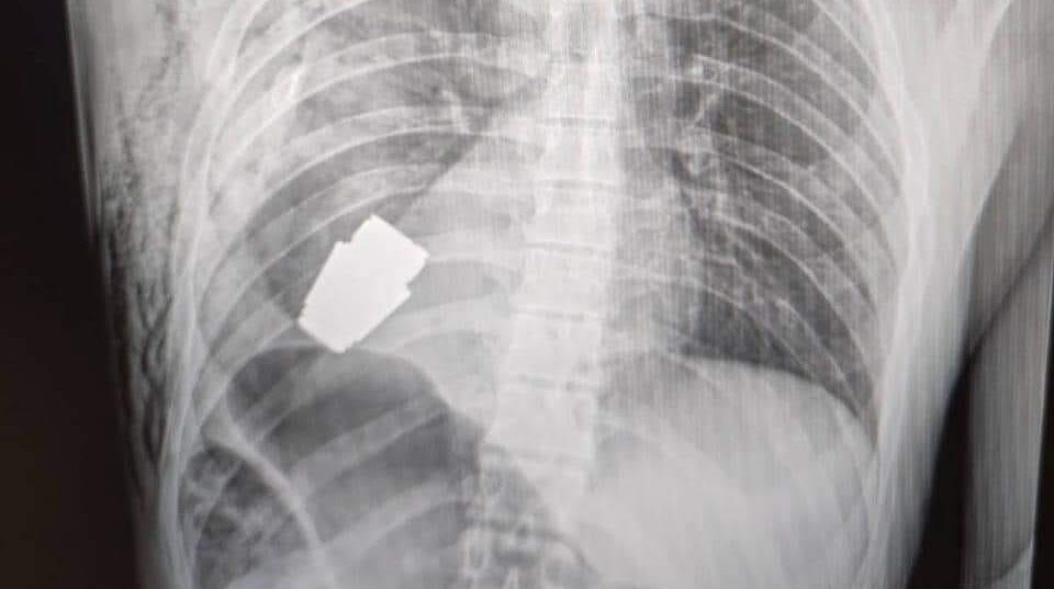 Grenadă neexplodată, extrasă din corpul unui soldat ucrainean (FOTO)