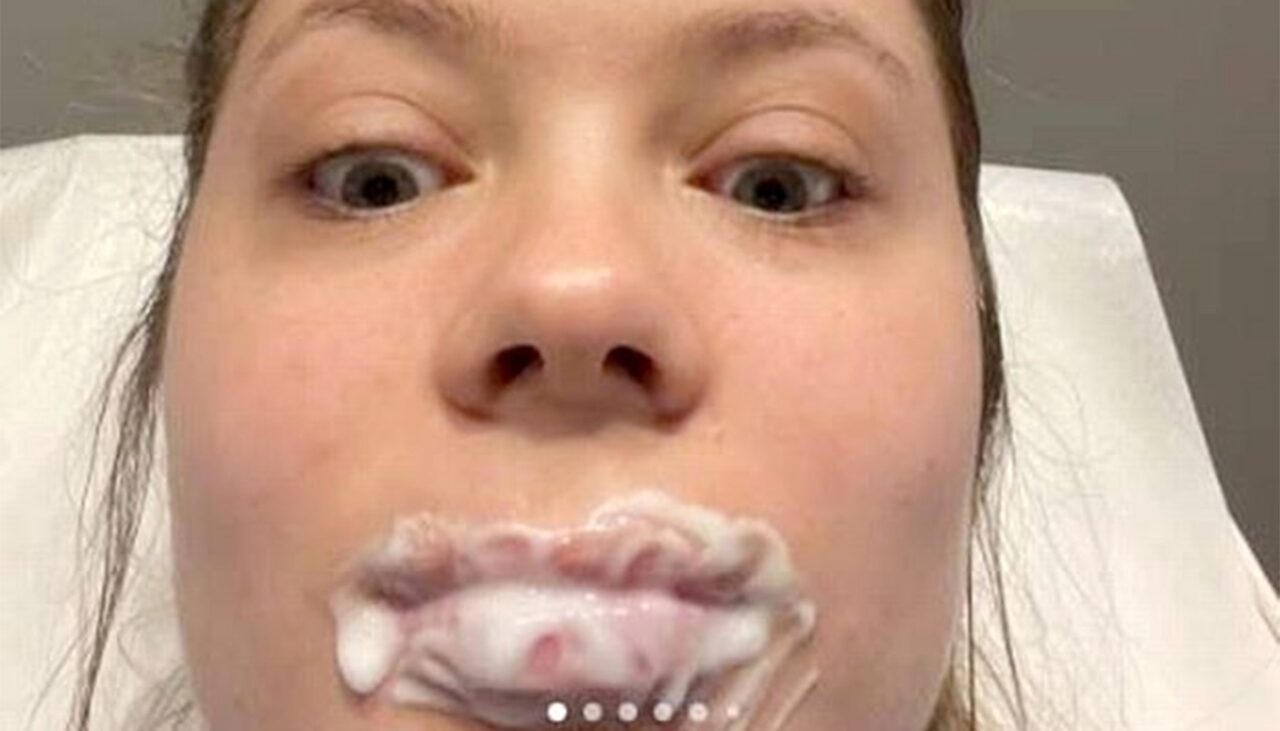 Ce a pățit TÂNĂRA din imagine, la exact 3 ore după ce a folosit lip filler cu acid hialuronic