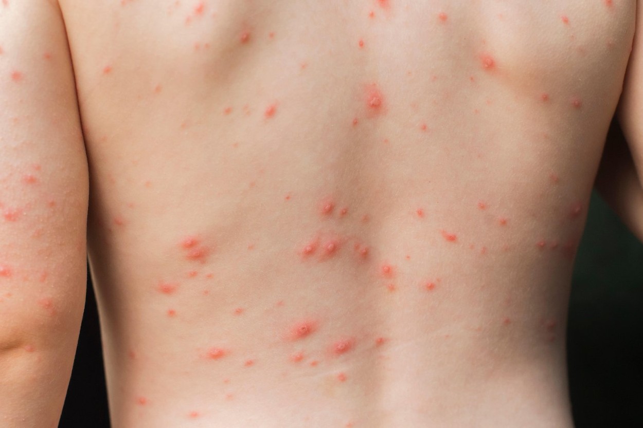Varicela hemoragică – o boală extrem gravă, îmbolnăvește copiii din România. Un băiețel de 7 ani este internat la Spitalul de Boli Infecţioase din Timişoara. Ce spun medicii