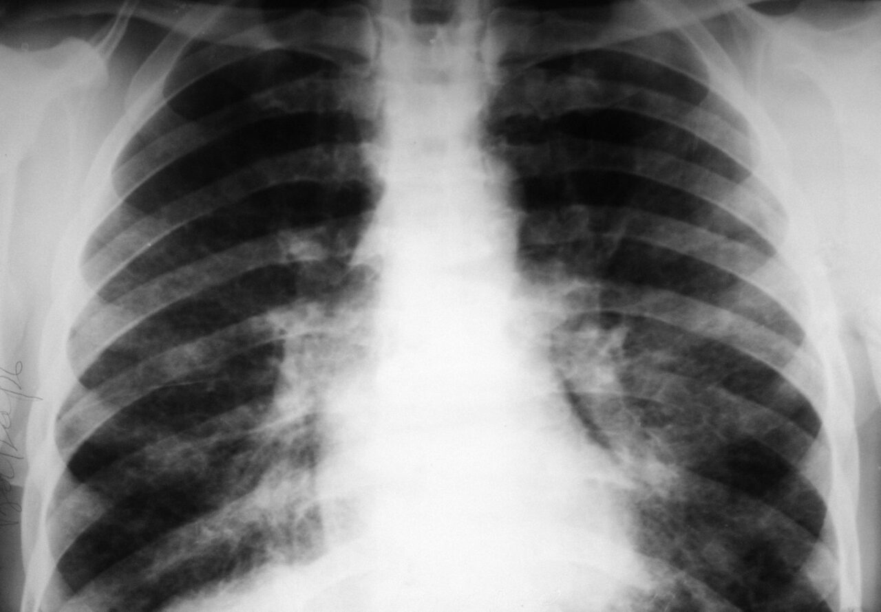 Neoplasm pulmonar, boala anului 2023. Avertismentul medicilor: nu doare, dar este fatală! Semnele care trebuie să te îngrijoreze