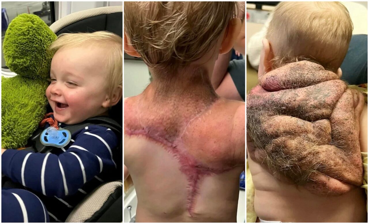 Un băiețel s-a născut cu o ”carapace” pe spate. Părinții nu au știut ce să facă când au văzut cum arată copilul lor