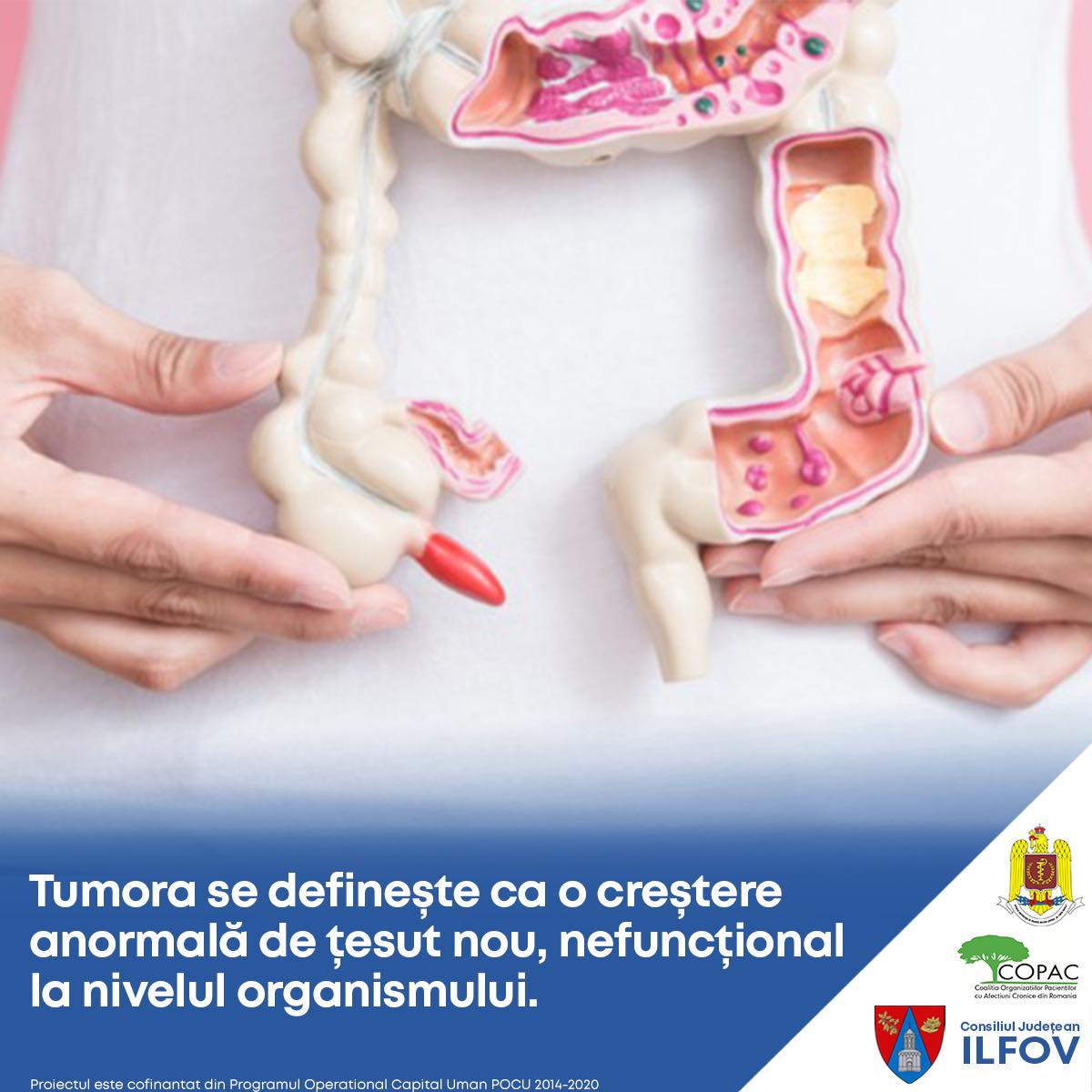 Program de prevenție, depistare precoce, diagnostic și tratament precoce al leziunilor precanceroase colorectale la nivelul județului Ilfov (P)