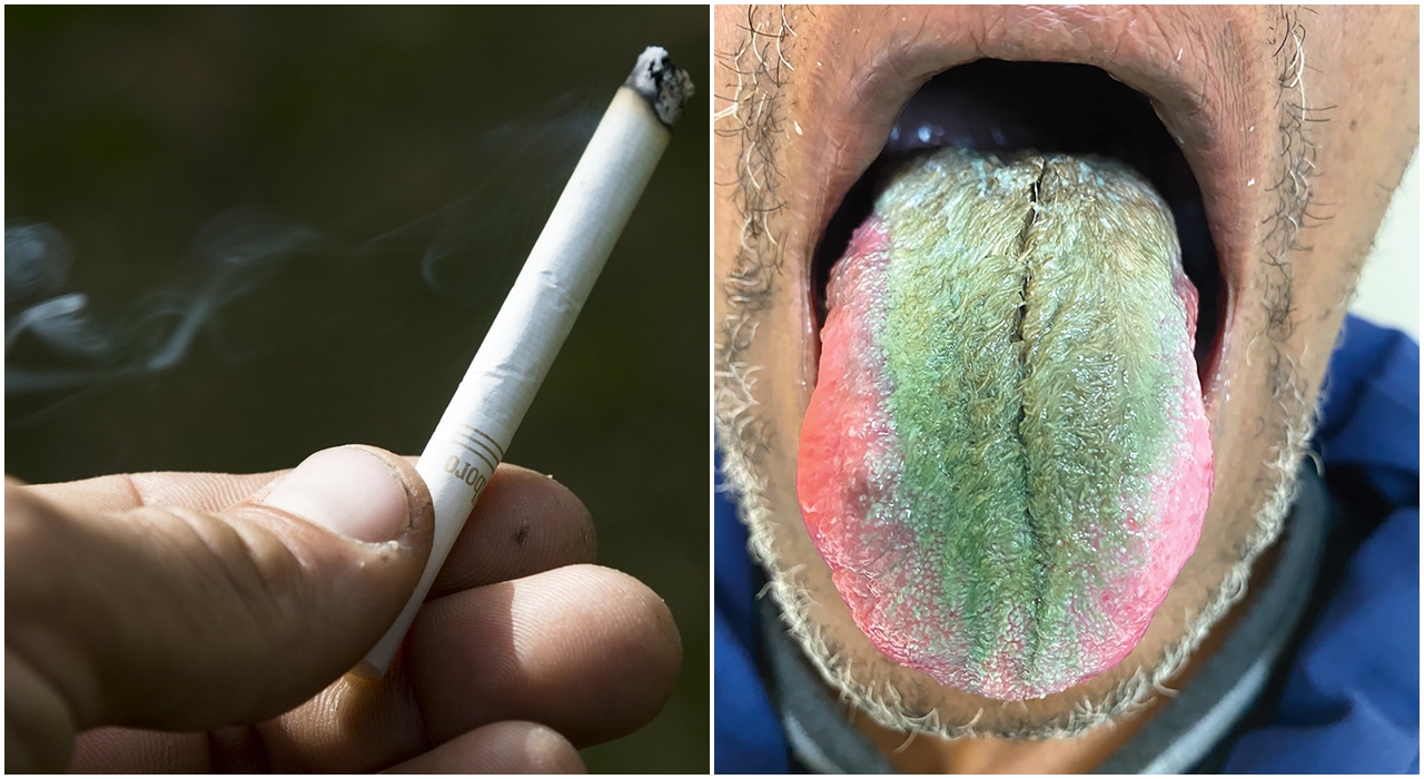 Un fumător s-a trezit cu LIMBA „verde și păroasă”. Cazul lui, trimis direct la Academia Americană de Medicină Orală
