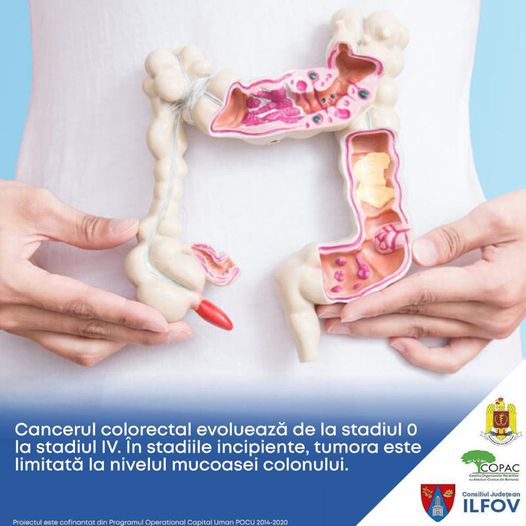 Locuitorii județului Ilfov se pot înscrie în continuare în programul împotriva leziunilor precanceroase colorectale (P)