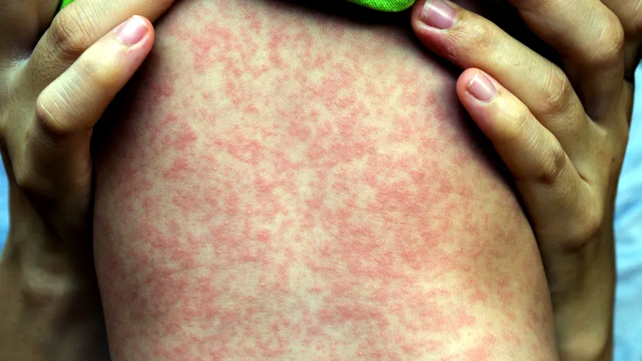 5 boli CUMPLITE din istoria omenirii care se întorc, deși fuseseră eradicate