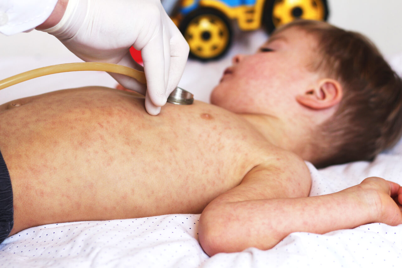 OMS recomandă vaccinarea de urgență a copiilor împotriva rujeolei în Europa. Numărul de cazuri, de zeci de ori mai mare în 2023 față de anul anterior