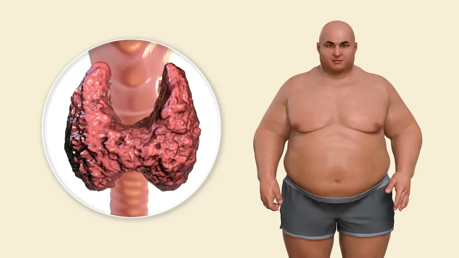5 remedii naturale pentru hipotiroidism. Cum tratezi tiroida LENEȘĂ, care nu te lasă să slăbești