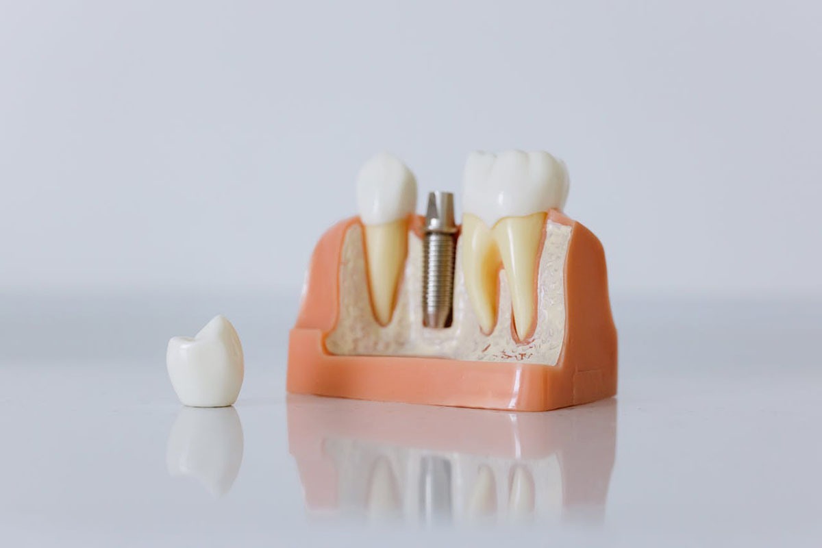 (P) Află aici informații despre implantul dentar obținut în doar 24 de ore