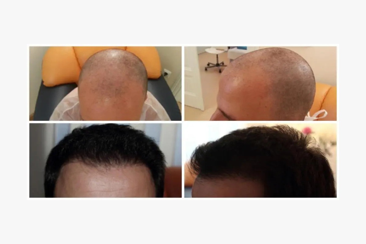(P) Cum scapi de alopecie? Află aici informații despre implantul de păr și tehnica Q-FUE