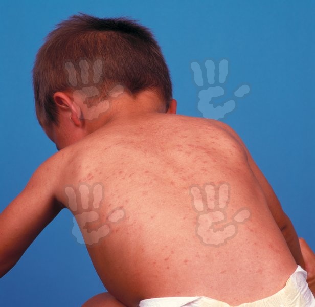 Rujeola a început să-i ucidă și pe părinții NEVACCINAŢI. Un bărbat de 41 de ani, nevaccinat, care a luat boala de la fiul său, a decedat