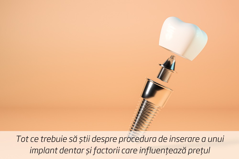 (P) Tot ce trebuie să știi despre procedura de inserare a unui implant dentar și factorii care influențează prețul