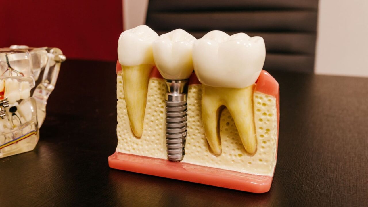(P) Se poate face implantul dentar în etape, plătite pe parcurs?