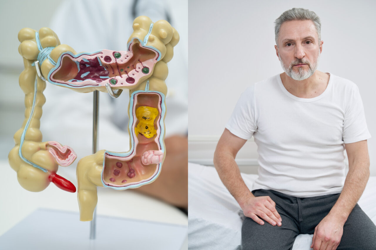 Cancerul de colon la tineri, diferit de cel apărut după 50 de ani. Ce arată un nou studiu australian
